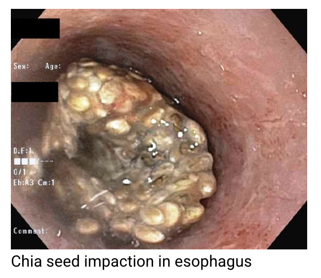 are chia seeds a choking hazard, chia seeds stuck in esophagus, chia seeds side effects